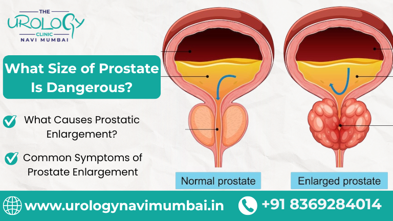What Size of Prostate Is Dangerous?