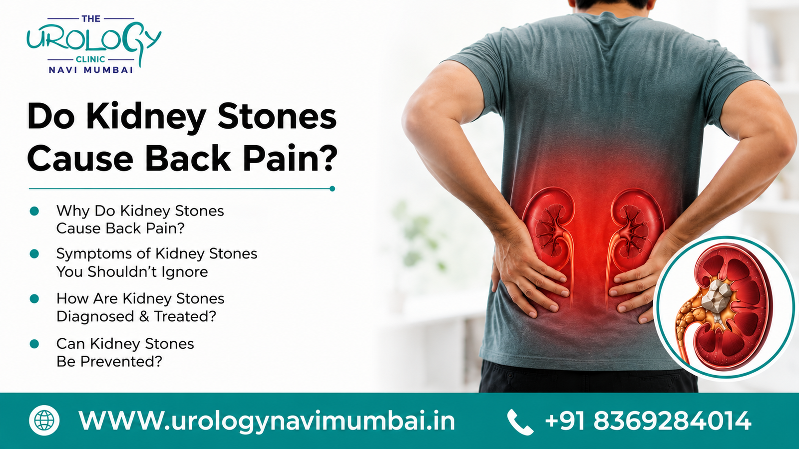 Do kidney stones cause back pain​