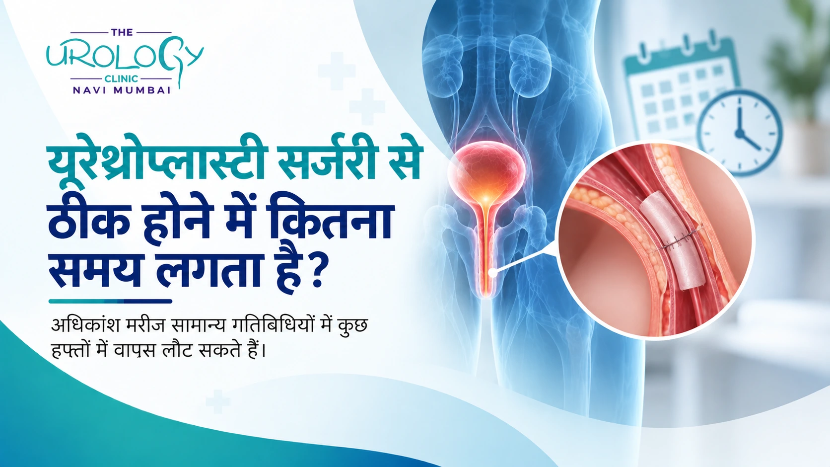 यूरेथ्रोप्लास्टी सर्जरी से ठीक होने में कितना समय लगता है?