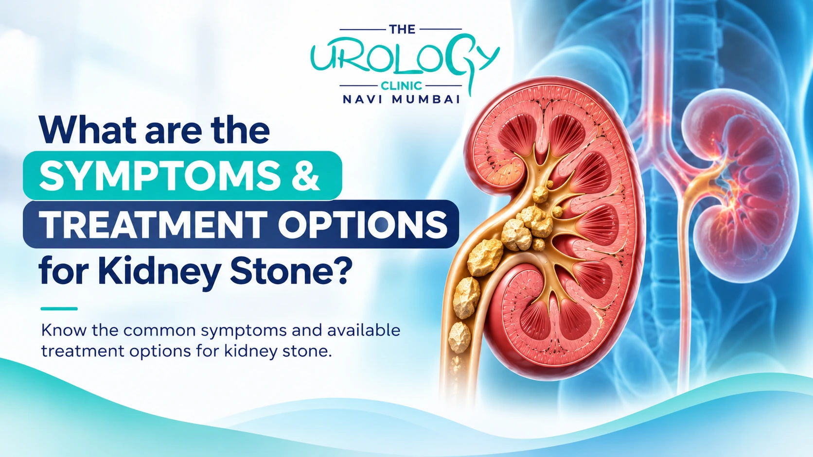 What Are the Symptoms and Treatment Options for Kidney Stones?